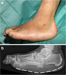 Charcot joint, also known as neuropathic arthropathy or Charcot neuroarthropathy, is a progressive, destructive joint disorder characterized by fragmentation, dislocation, and deformity of bones and joints. It occurs in the setting of peripheral neuropathy, where loss of protective sensation leads to repeated trauma and inflammation unnoticed by the patient.