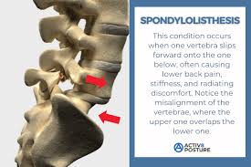 Spondylolisthesis is a spinal condition where one vertebra slips forward over the vertebra below it, causing misalignment of the spine. It most commonly affects the lower lumbar spine but can occur elsewhere. The slippage can compress nerves, leading to pain and neurological symptoms.