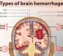 Intracranial hemorrhage (ICH) refers to bleeding within the skull, which may occur in the brain parenchyma, surrounding meningeal layers, or ventricles. It is a medical emergency requiring immediate intervention to prevent permanent brain damage or death178.