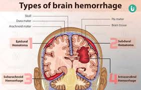 Intracranial hemorrhage (ICH) refers to bleeding within the skull, which may occur in the brain parenchyma, surrounding meningeal layers, or ventricles. It is a medical emergency requiring immediate intervention to prevent permanent brain damage or death178.