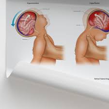 Shaken Baby Syndrome (SBS), also known as abusive head trauma, is a severe brain injury that occurs when an infant or young child is violently shaken. The shaking causes the child's brain to move back and forth within the skull, resulting in bruising, swelling, and bleeding in and around the brain. This can lead to permanent brain damage or death12369.