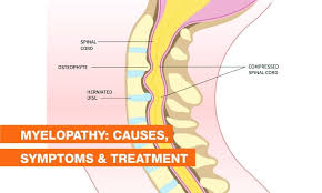 Myelopathy refers to spinal cord compression that leads to neurological deficits. When this compression occurs in the cervical spine (neck region), it is called cervical myelopathy, the most common type of myelopathy. It results from narrowing of the spinal canal, which puts pressure on the spinal cord, impairing nerve signal transmission to and from the brain.