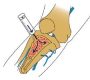 Intraosseous (IO) injection involves delivering therapeutic agents (e.g., stem cells, platelet-rich plasma [PRP], bone marrow concentrate [BMC]) directly into the bone marrow cavity. This method is increasingly used in regenerative medicine to treat advanced osteoarthritis (OA), bone marrow lesions, and other bone-related disorders by targeting the subchondral bone—the layer beneath cartilage often damaged in degenerative joint disease.