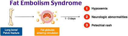 A fat embolism occurs when fat droplets enter the bloodstream and lodge in small blood vessels, obstructing blood flow. When this leads to a constellation of clinical symptoms, it is termed fat embolism syndrome (FES). FES is most commonly seen after trauma—particularly long bone (femur, tibia) or pelvic fractures—or orthopedic surgery, but can also occur in non-traumatic conditions such as pancreatitis, fatty liver disease, bone marrow transplant, and liposuction246.