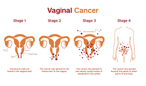 Vaginal cancer (VGC) is a rare malignancy that primarily affects women over the age of 60, with risk increasing significantly in older age groups, especially those over 70. The development of vaginal cancer is strongly linked to several risk factors, most notably infection with the human papillomavirus (HPV).