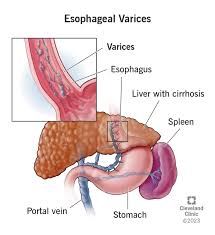 Variceal bleeding refers to bleeding from varices, which are abnormally dilated and fragile veins that develop due to increased pressure in the portal venous system (portal hypertension). These varices commonly occur in the esophagus, stomach, and less commonly in the rectum or abdominal wall. When these fragile veins rupture, they cause potentially life-threatening gastrointestinal bleeding.
