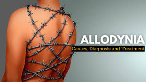 Allodynia is a condition characterized by pain resulting from a stimulus that normally does not provoke pain. For example, a light touch such as a feather brushing the skin or wearing soft clothing can cause significant pain123.