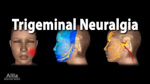 Trigeminal neuralgia (TN) is a chronic pain condition characterized by sudden, severe, stabbing or electric shock-like pain in areas supplied by the trigeminal nerve, which includes the forehead, cheek, jaw, and around the eyes. The pain typically affects one side of the face and can be triggered by everyday activities such as chewing, speaking, brushing teeth, or even a light touch.