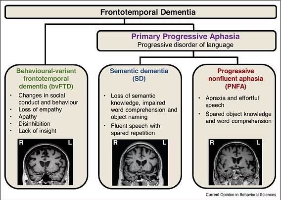 Frontotemporal dementia (FTD) is a group of brain disorders caused by progressive nerve cell loss in the frontal and temporal lobes of the brain, areas associated with personality, behavior, and language. It typically affects people between the ages of 40 and 65 but can occur earlier or later. FTD is characterized by gradual but steady worsening of symptoms that vary depending on the brain regions involved.
