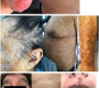 Syphilis is a sexually transmitted infection (STI) caused by the bacterium Treponema pallidum. It is primarily spread through direct contact with syphilitic sores during vaginal, anal, or oral sex, but can also be transmitted from mother to child during pregnancy or childbirth1234. Without treatment, syphilis can progress through several stages, potentially causing severe damage to the heart, brain, and other organs, and can be life-threatening124.