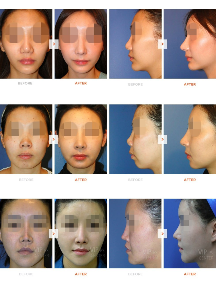Facial surgery's Autologous fat transfer (using your own fat) in facial reconstructive / aesthetic cases: meta-analysis of >1,500 patients showed ~91% patient satisfaction