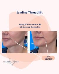 Jawline definition threadlift