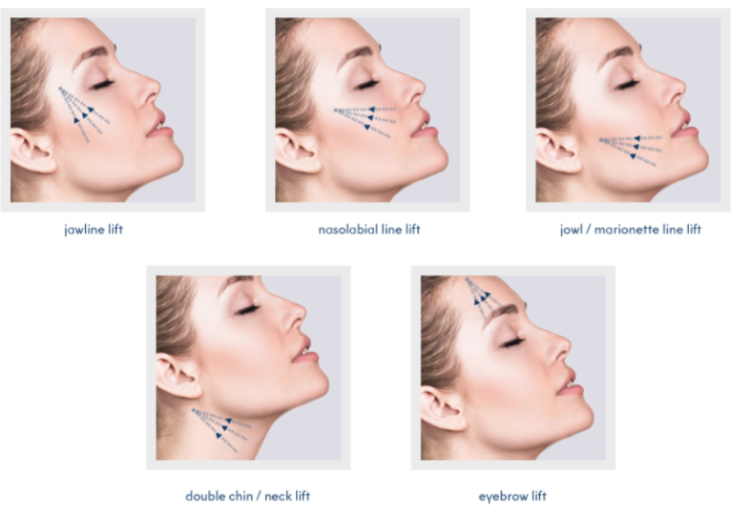 Skin Care & Laser Dermatology : Sagging cheeks or jowls: Restores lifted V-shape.