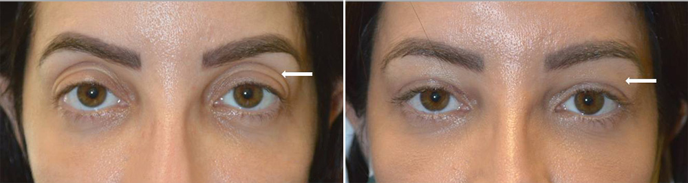 Eye Cosmetic Surgery : Upper Eyelid Fat Removal