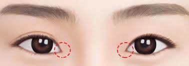 Advanced Eye Cosmetic Surgery :  White-Eye Enlargement Surgeries 