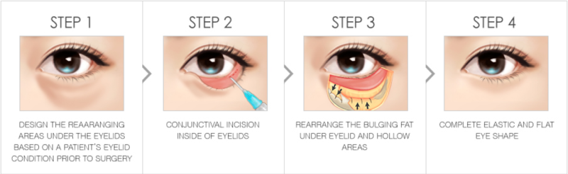 Advanced Eye Cosmetic Surgery : NIP Non-incisional Ptosis Correction (2M KW)