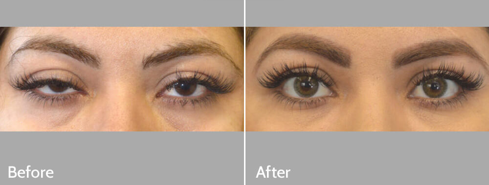 Advanced Eye Cosmetic Surgery :   Eye Ptosis + Width & Length Extension (4M KW)