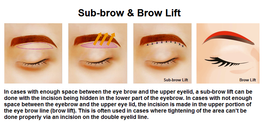 Eye Cosmetic Surgery :  Subbrow Lift