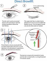 Eye Cosmetic Surgery : Suprabrow Lift