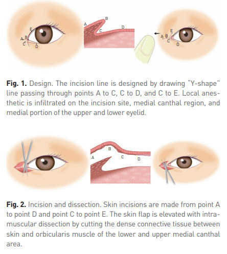 Eye Cosmetic Surgery : Epicanthoplasty