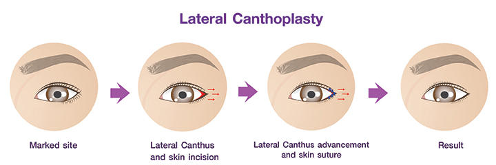 Eye Cosmetic Surgery :  Lateral Epicanthoplasty