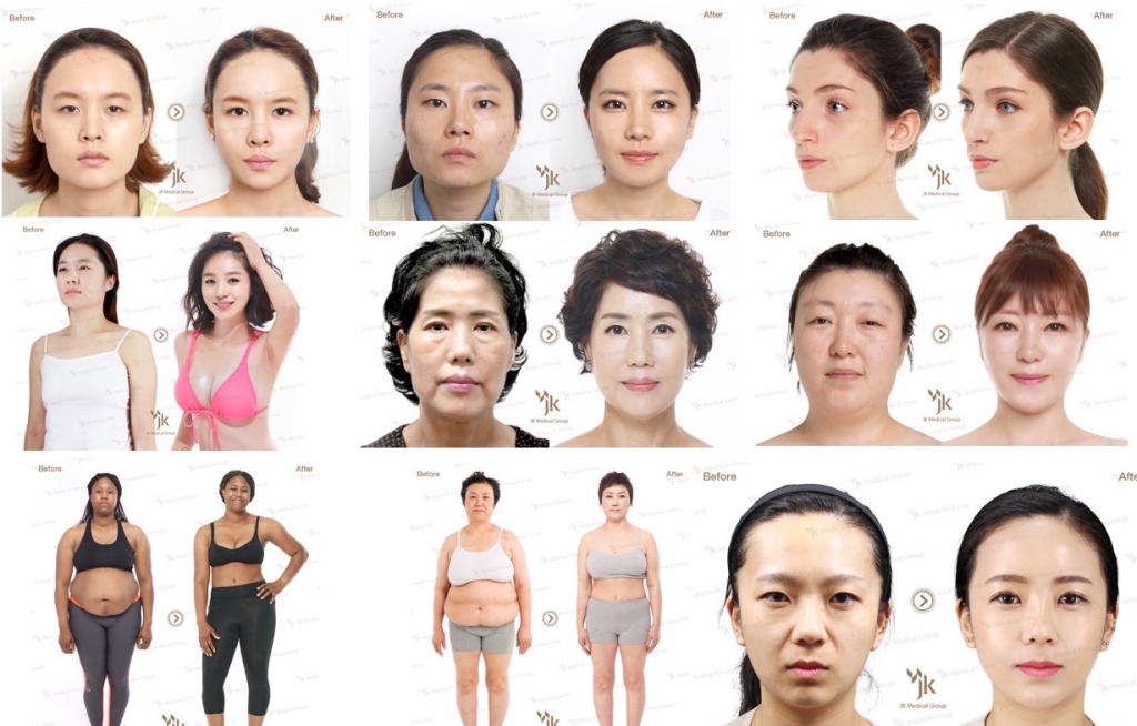 Cosmetic and plastic facial surgery is more than skin deep. It’s about self-esteem, professional confidence, emotional wellbeing. For many international patients, undergoing transformation in a world-renowned aesthetic center like Gangnam offers not only results but an experience — comfort, privacy, healing, and return to daily life with new confidence.