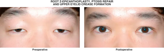 Eye Cosmetic Surgery :  Upper Epicanthoplasty