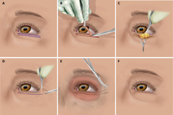 Lower Blepharoplasty