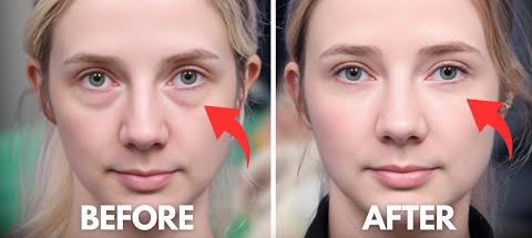 Eye Cosmetic Surgery :  Undereye Fat Reposition