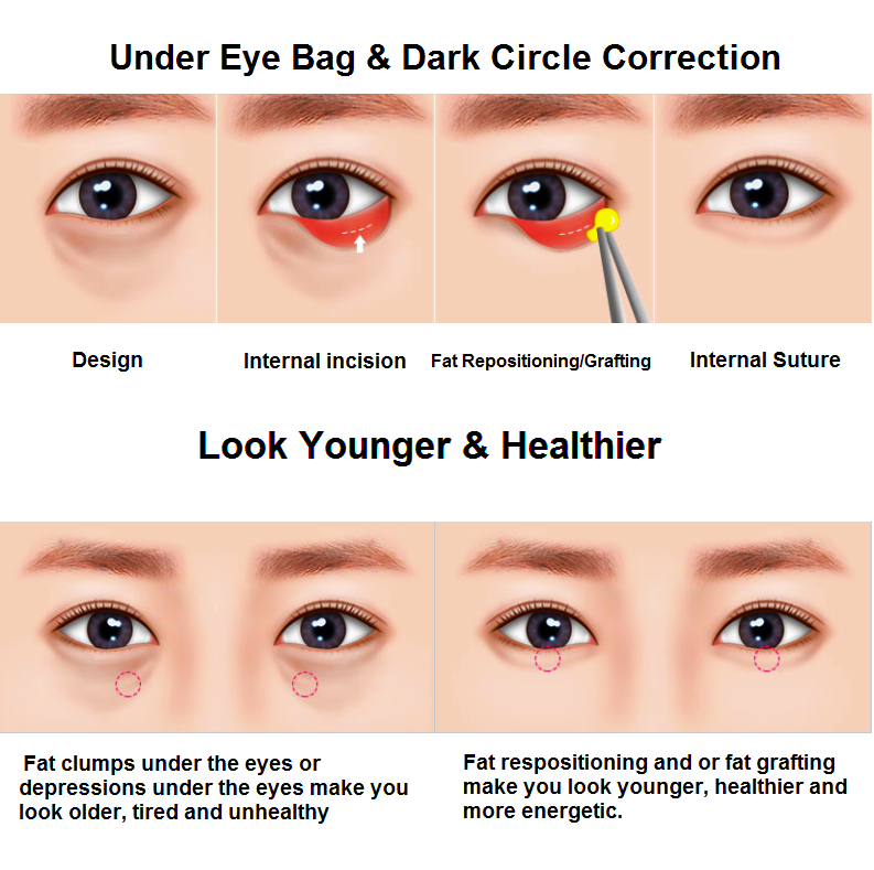  Undereye Fat Removal