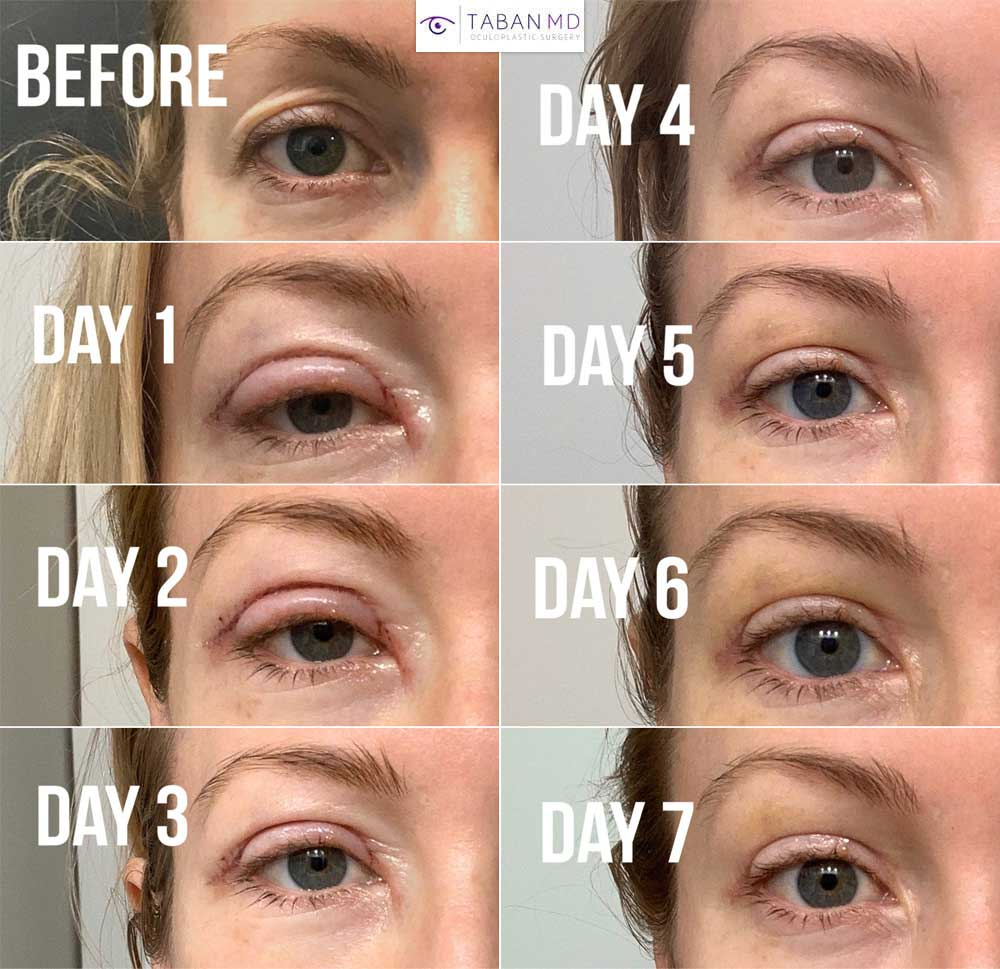  Upper Blepharoplasty + Ptosis Correction