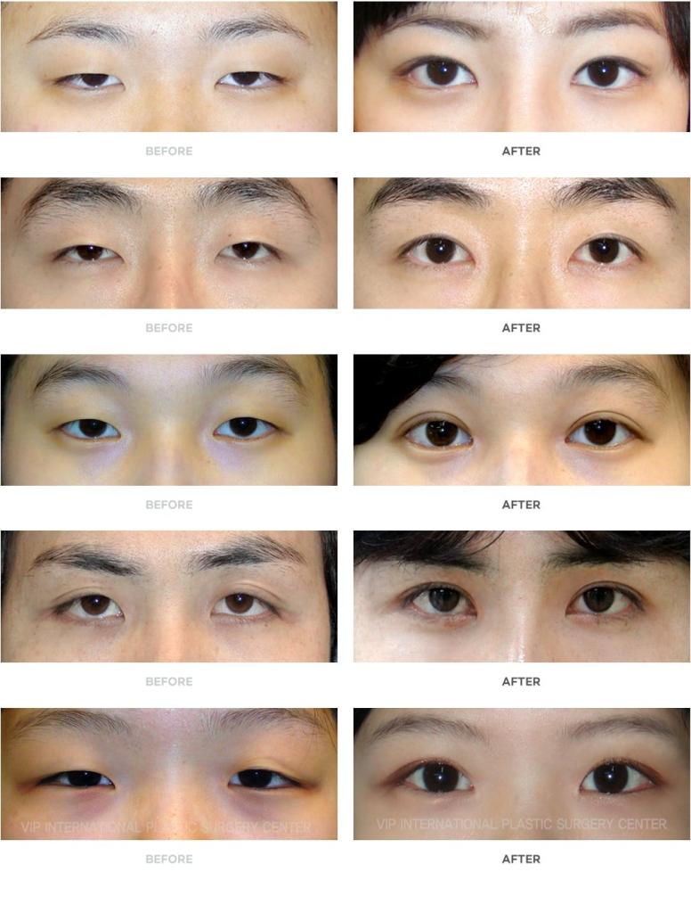 Double Eyelid Surgery 