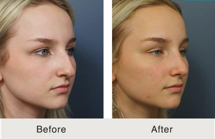 Bridge + Tip Rhinoplasty (AR + Tip) 