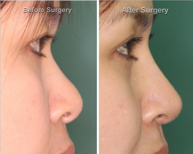 Bridge Rhinoplasty (AR Bridge)