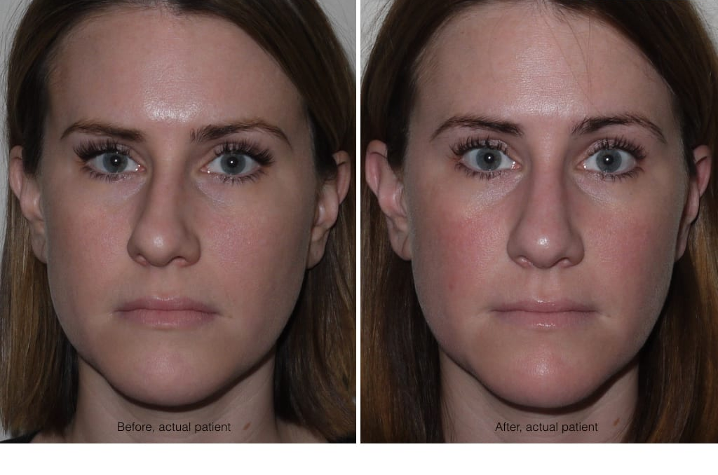 Septoplasty (Septum Correction)