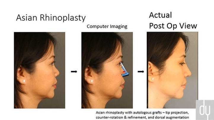 Cartilage Graft Rhinoplasty