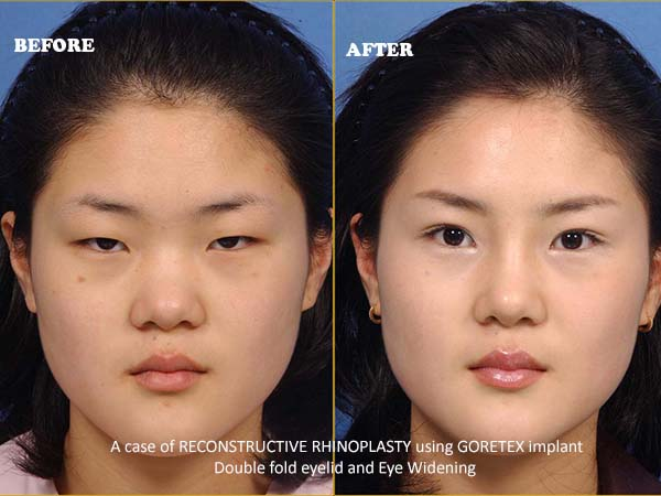 Gore-Tex Bridge Rhinoplasty (AR Goertex)