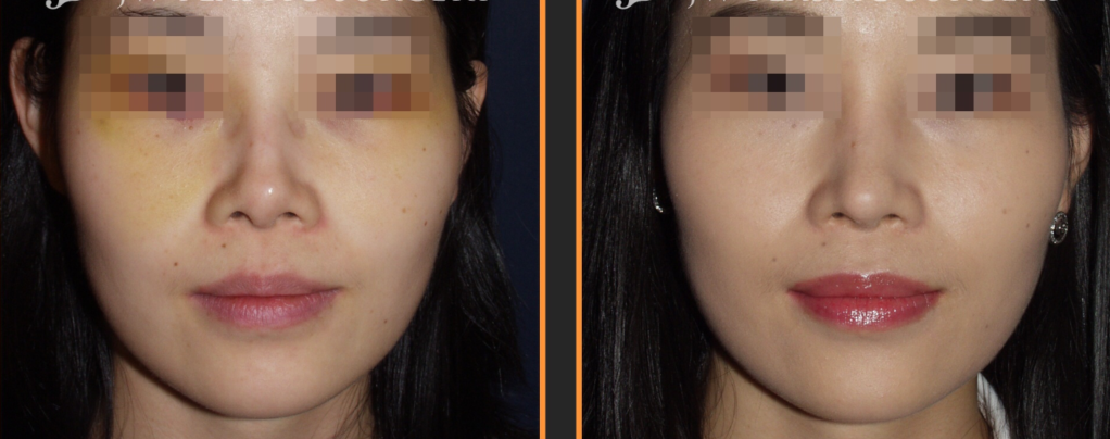 Alloderm Bridge Rhinoplasty (AR Al)