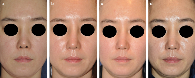 Dermofat Bridge Rhinoplasty