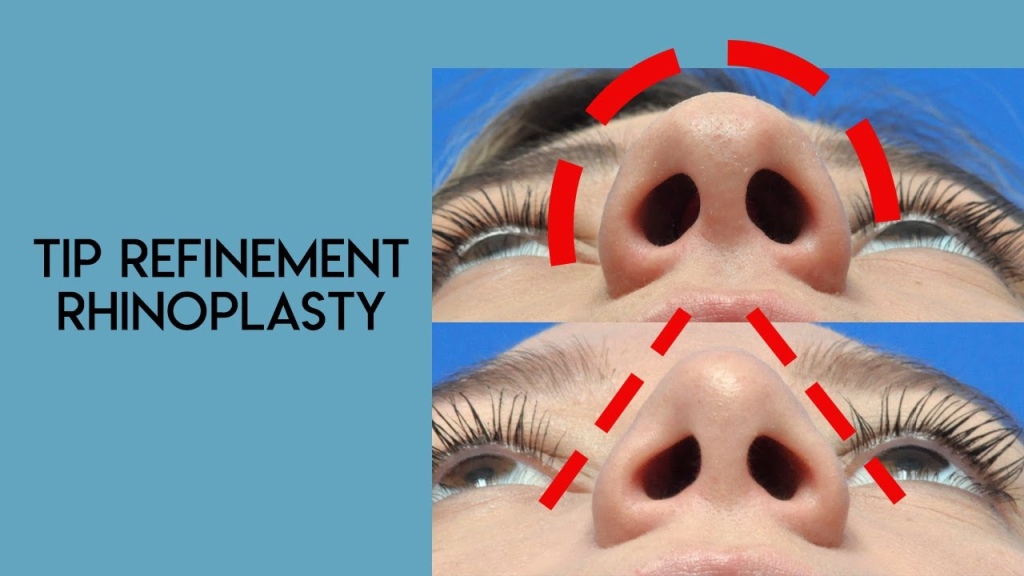 Tip Refinement Procedures