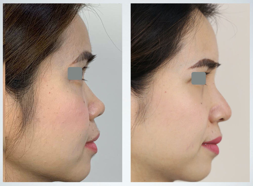 Tip Alloderm Rhinoplasty (Tip A)