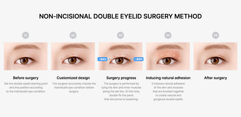 Eye Cosmetic Surgery : Non-Incisional Double Eyelid Surgery