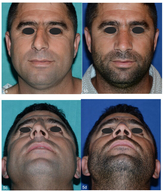 Nasal Osteotomy (OT)