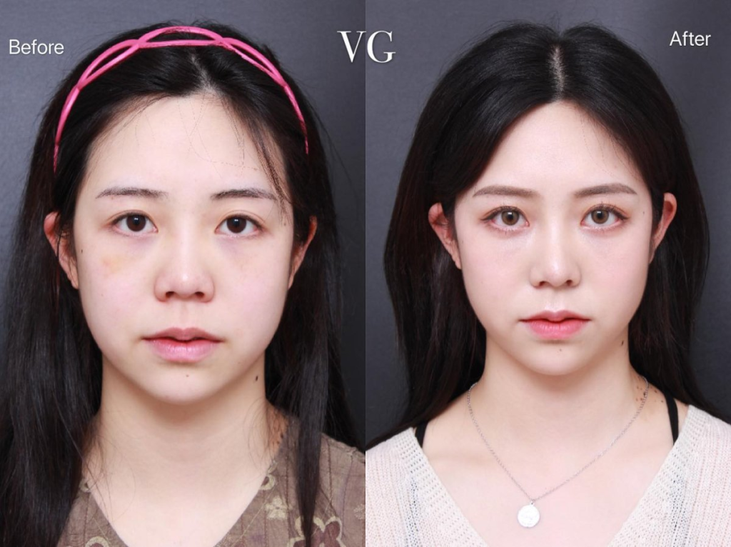 Alar Reduction (AR)