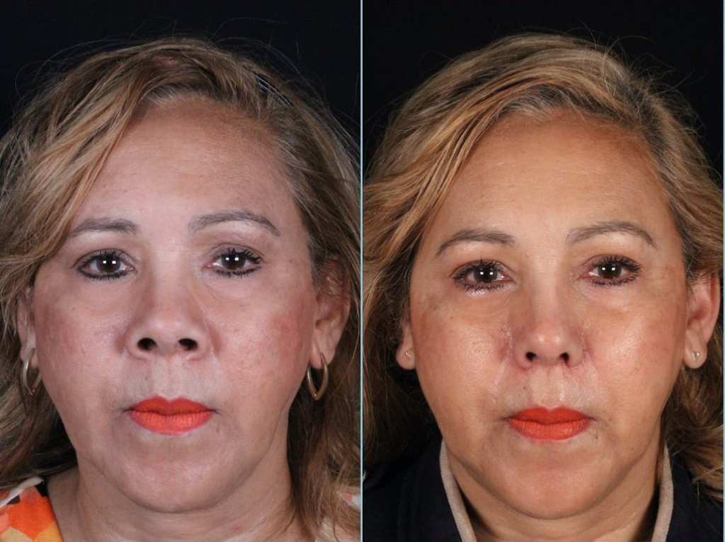 Correction of Nostril Show (CNS)