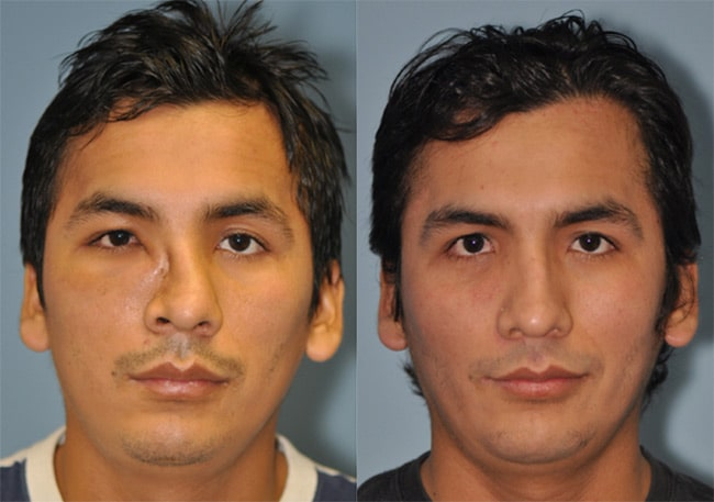 Deviated Nose Correction (DN)