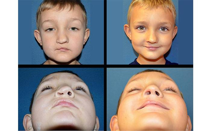 Cleft Nose Correction (CN)