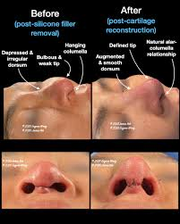 Filler Removal (Fr)
