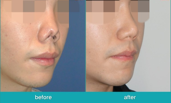 Contracted Nose (CTN)