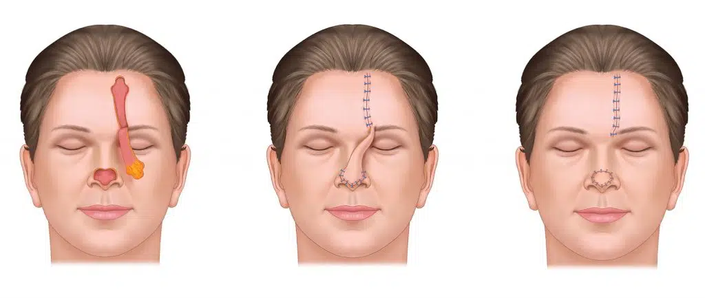 Forehead Flap (FH)